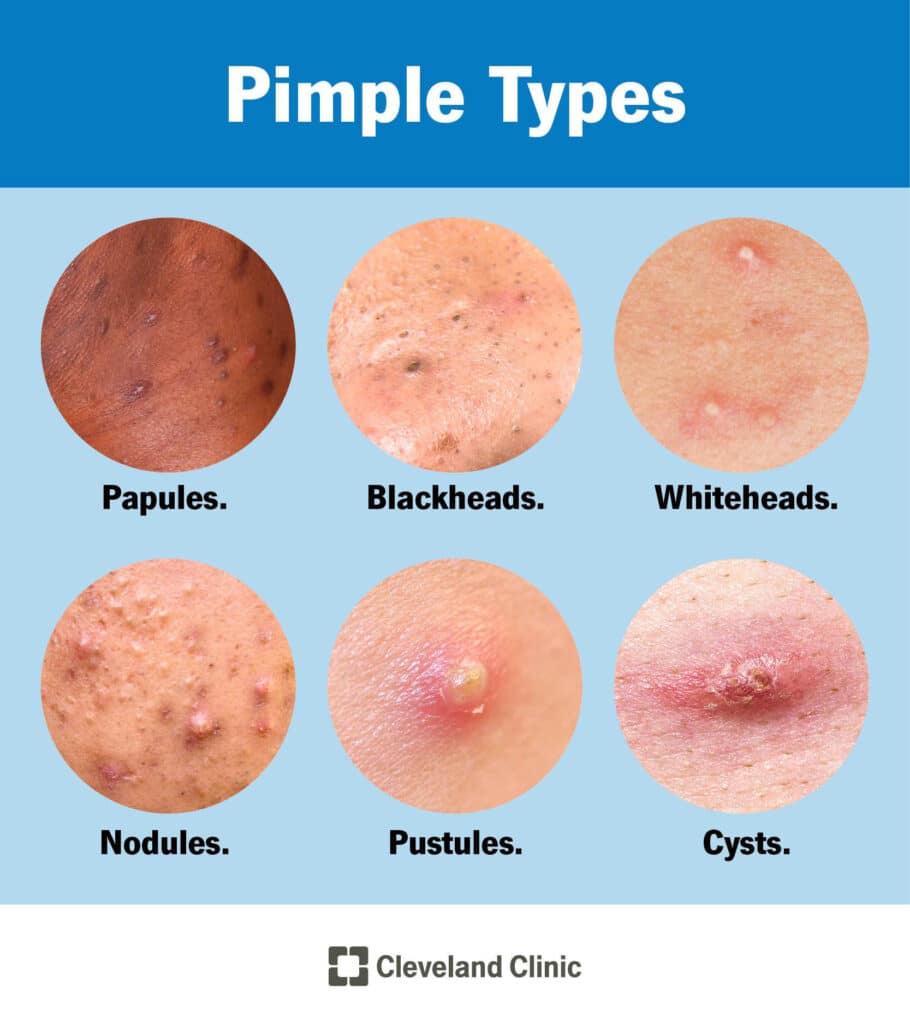 Types of Acne